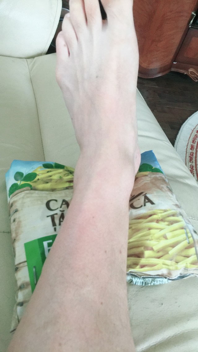 Fixing Achilles Pain